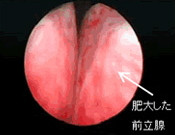 圧迫された尿道