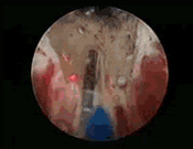 レーザーによる蒸散